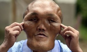 Mandatory Credit: Photo by Imaginechina/REX/Shutterstock (6034892i) Chinese villager Xia Yuanhai who has an alien-like deformed face Man has 'alien face', Changling town, Chongqing, China - 23 Sep 2016 A Chinese man was known to every one in his village because he has a big head and an alien-like deformed face. Xia Yuanhai, 53, lives in Laotu village in southwestern Chinese municipality of Chongqing. His apperance was normal when he was a teenager. But later hyperplasia was growing on his face and head, according to his 66-year-old brother Xia Yuanchang. As the growth of hyperplasia was very slow and his family was poor, Xia Yuanhai did not get enough attention from his parents and did not receive medical treatment. Many years later, the hyperplasia deformed Xia's face, crushing his teeth and nearly disabling his hearing. Now his brother hoped that some one can fund plastic surgeries to help his younger brother to get back his normal face.