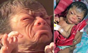 PIC FROM CATERS NEWS - (PICTURED: A baby boy who was born with a condition called Progeria in Bangladesh.) - A real life curious case of Benjamin Button has emerged following the birth of a baby boy who looks like an 80-year-old man. The baby was born in the district of Magura, Bangladesh, on Sunday. Local doctors, who have been left stunned, say the baby suffers from a rare condition called progeria. The baby boy has wrinkles on the face, has a very shrunken body and hollow eyes. The baby does not look like a new born at all. There are prominent sings of ageing such a excessive wrinkles and rough skin texture, said a doctor who has been treating the baby. However, the parents of the baby are jubilant with the birth of their miracle child. SEE CATERS COPY.